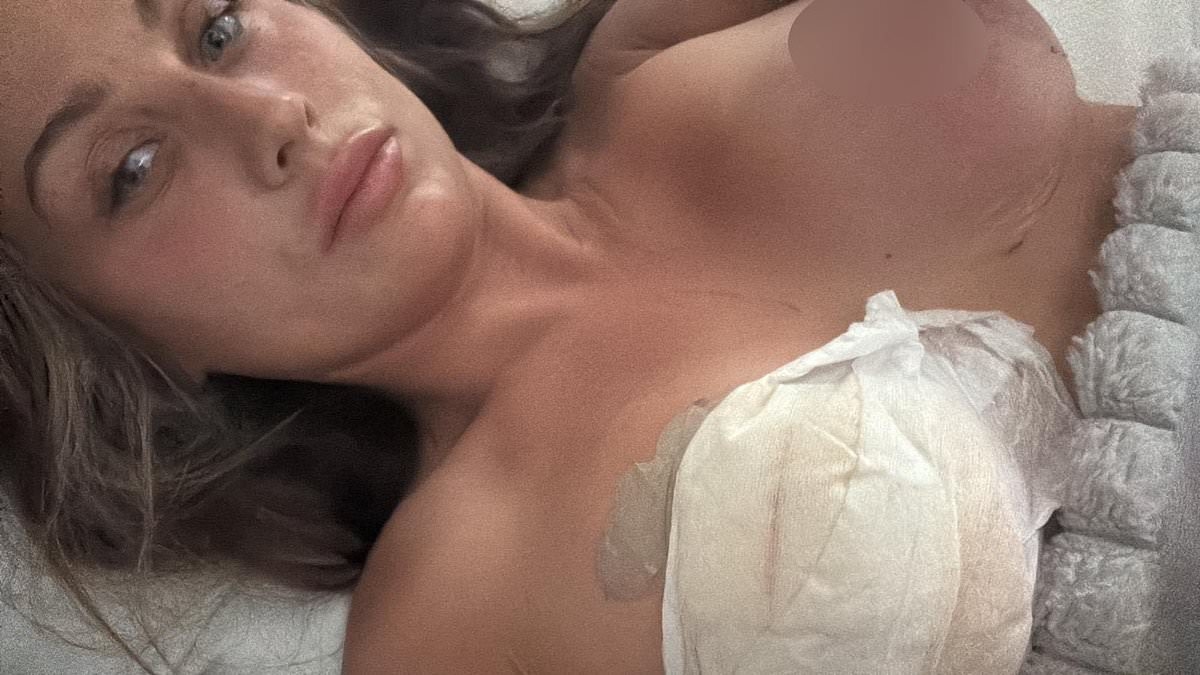 I ignored everyone's warnings and had a boob job in Turkey. The surgery nearly killed me and I've lost half my left nipple to necrosis. These are the mistakes I made and the signs I missed