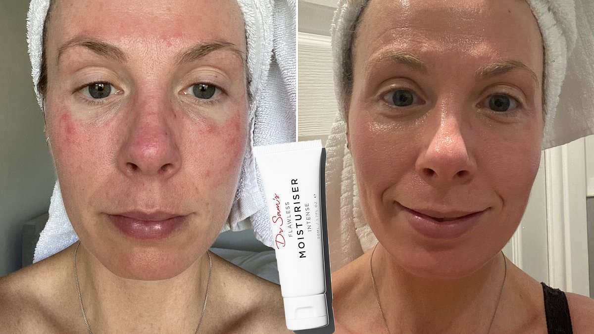 Dermatologist's ‘lifesaver' cream wins cult status for transforming sensitive skin: 'BEST face product I have ever used!'