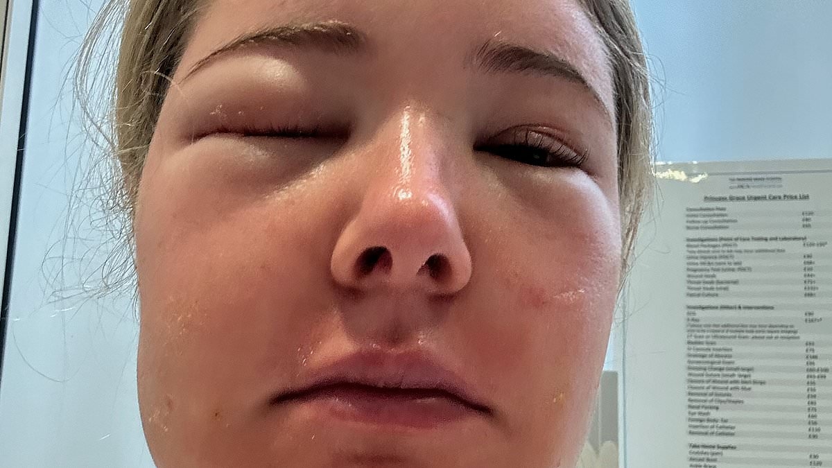 Heartbroken bride issues urgent warning after routine, pre-wedding 'glow-up' left her 'blind in one eye'