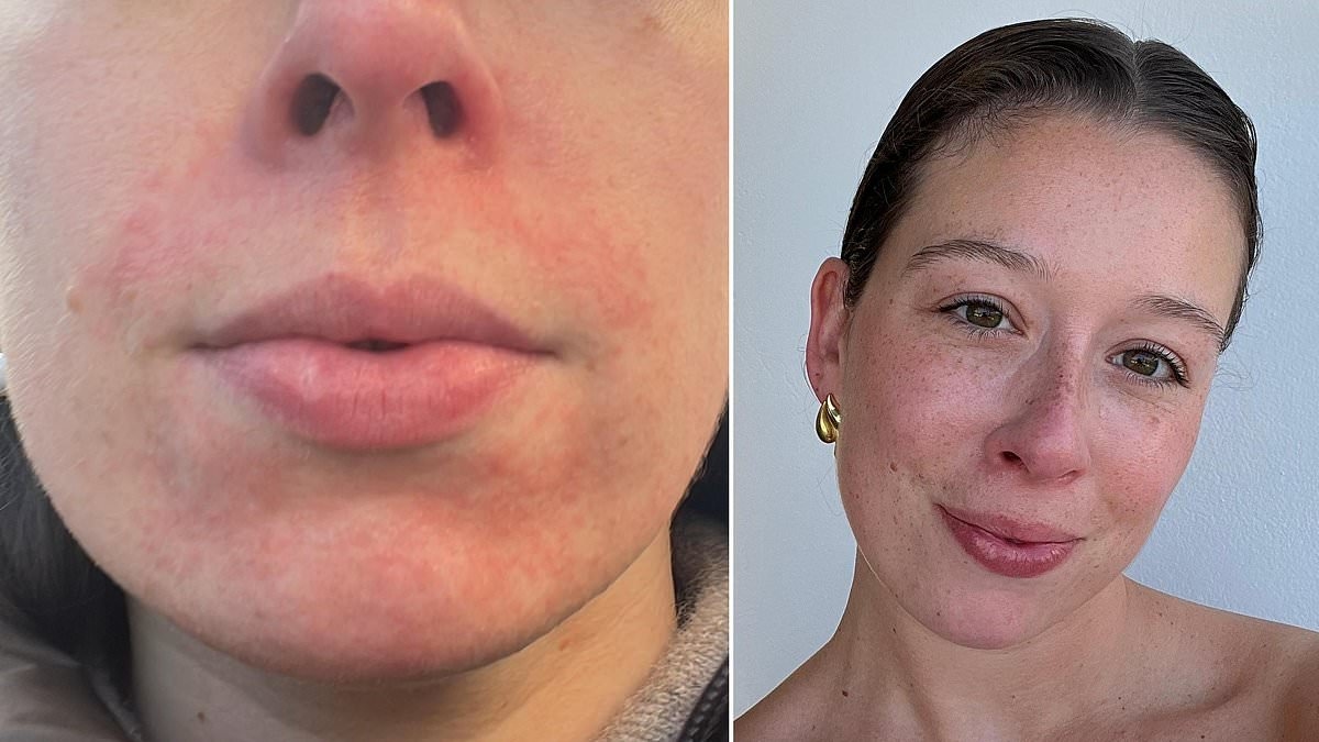 A cruel rash from a face cleaner marred my face. Three different GPs and three different treatments didn't help... then I found the answer that anyone who gets allergic reactions needs to know: CHARLOTTE VOSSAN