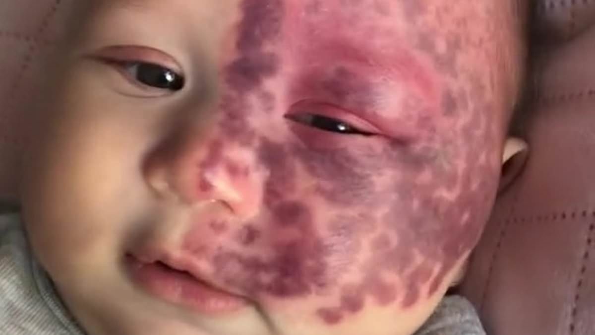 Mother branded a 'monster' for using controversial laser treatment on her baby son's birthmark reveals what he looks like three years later
