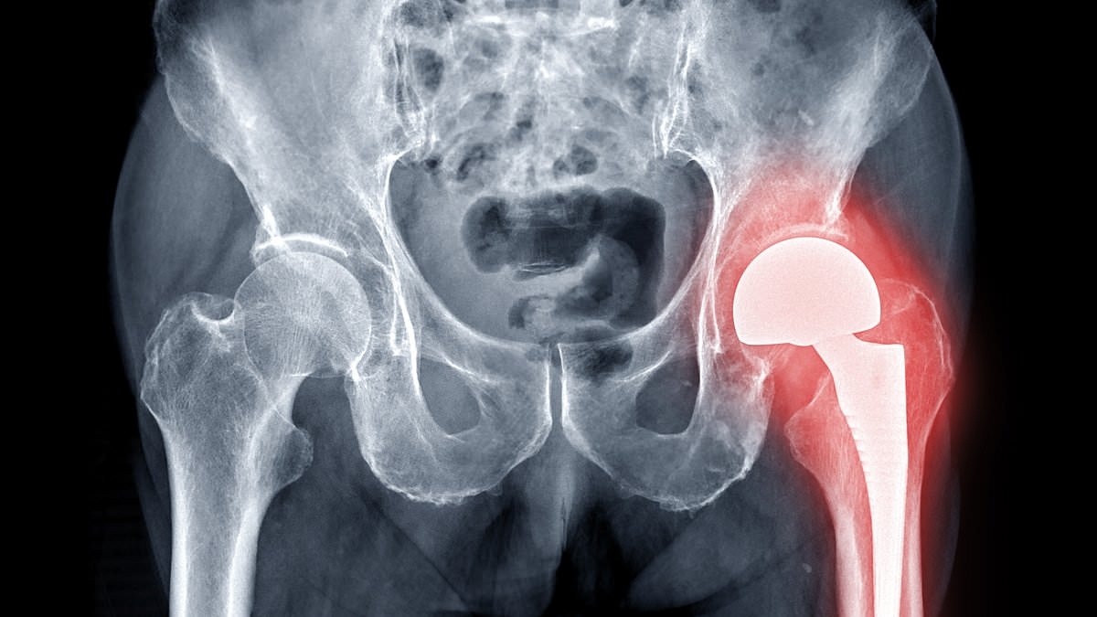 Doctor warns weight loss jabs will trigger 'tsunami of osteoporosis' as new evidence reveals it's not just fat that people are losing