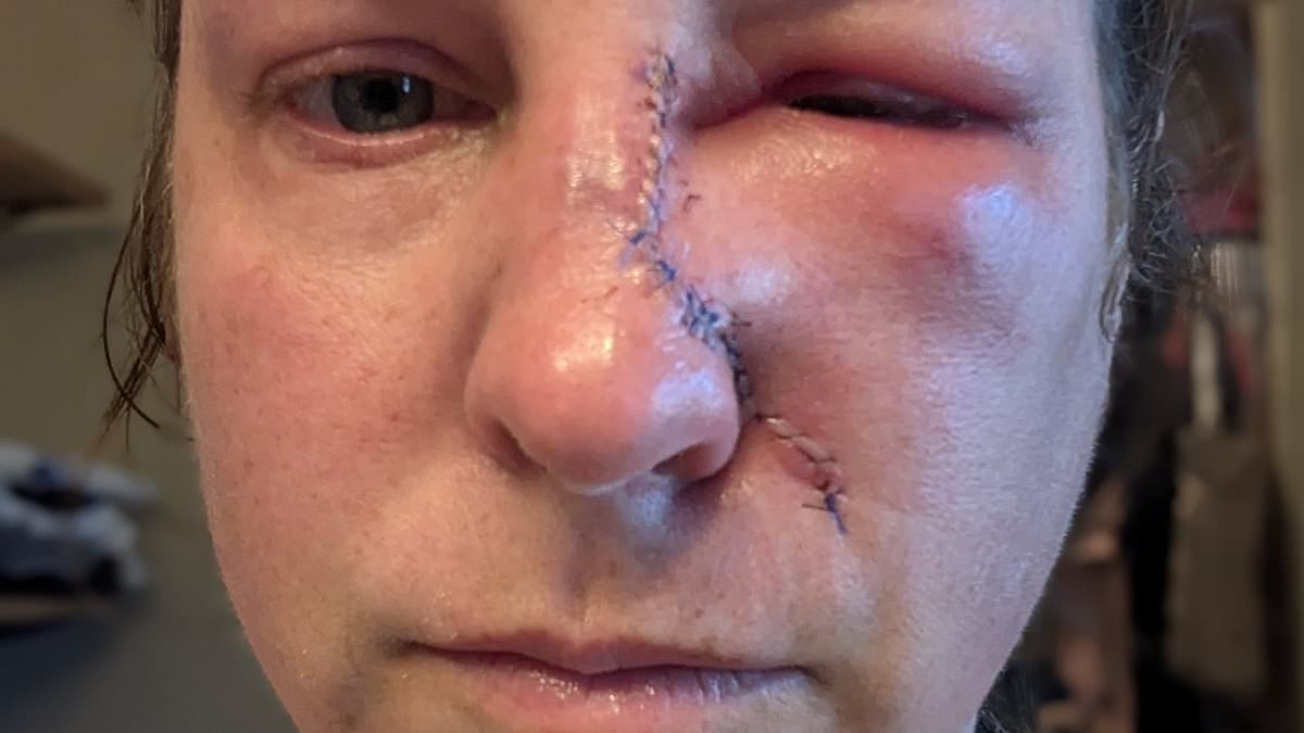 Mother-of-four, 43, reveals subtle mark she thought was just dry skin - but it was skin cancer: 'I ALWAYS wore sunscreen'