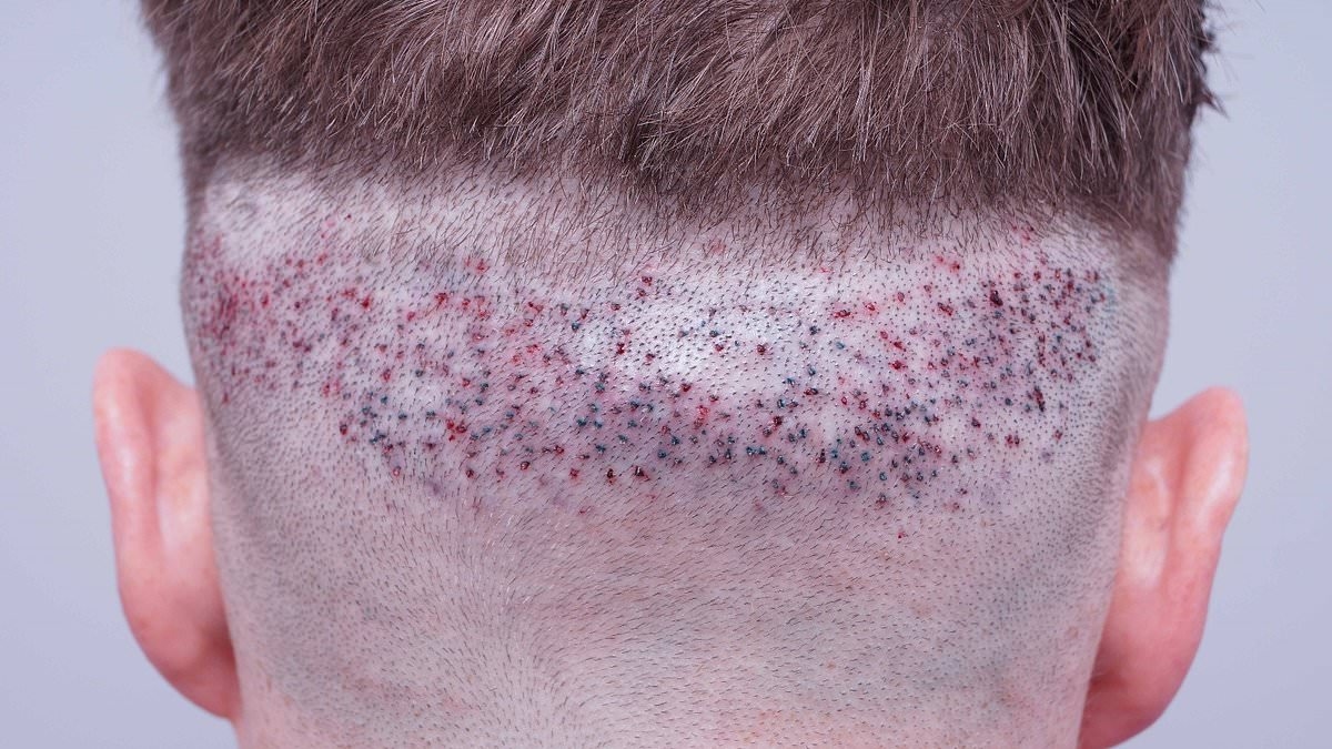 Hair transplant experts issue warning about UK clinics leaving men disfigured and depressed: 'Worse than Turkey'