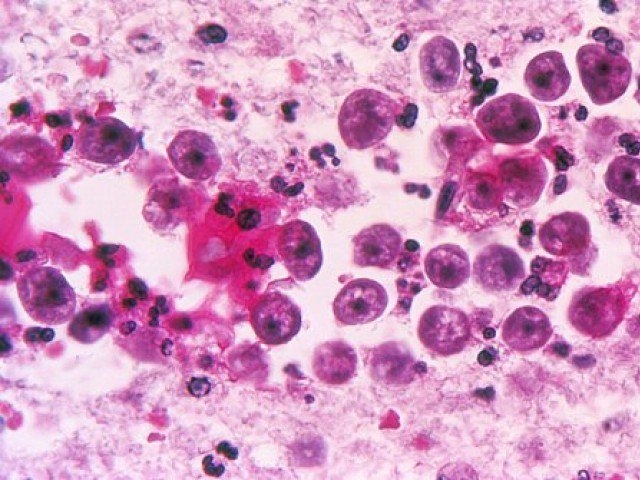 Karachi records first death from Naegleria fowleri this year