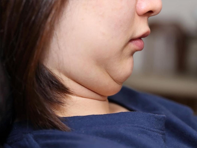Want to get rid of double chin? Here's what you can do