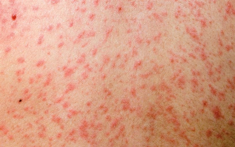 Measles claims territory in District East
