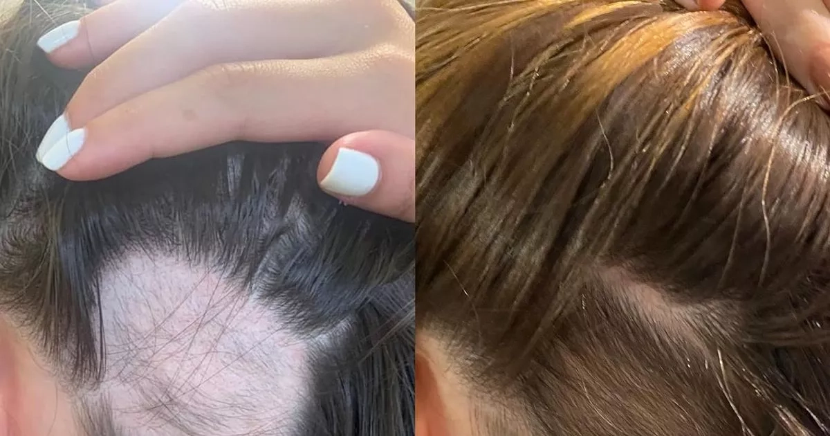 Beauty fans say hair loss 'stopped in tracks' by 'must have' 27p gummies