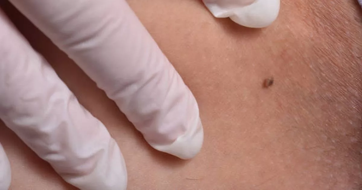 Skin expert shares why everyone should look out for ‘ugly duckling' moles