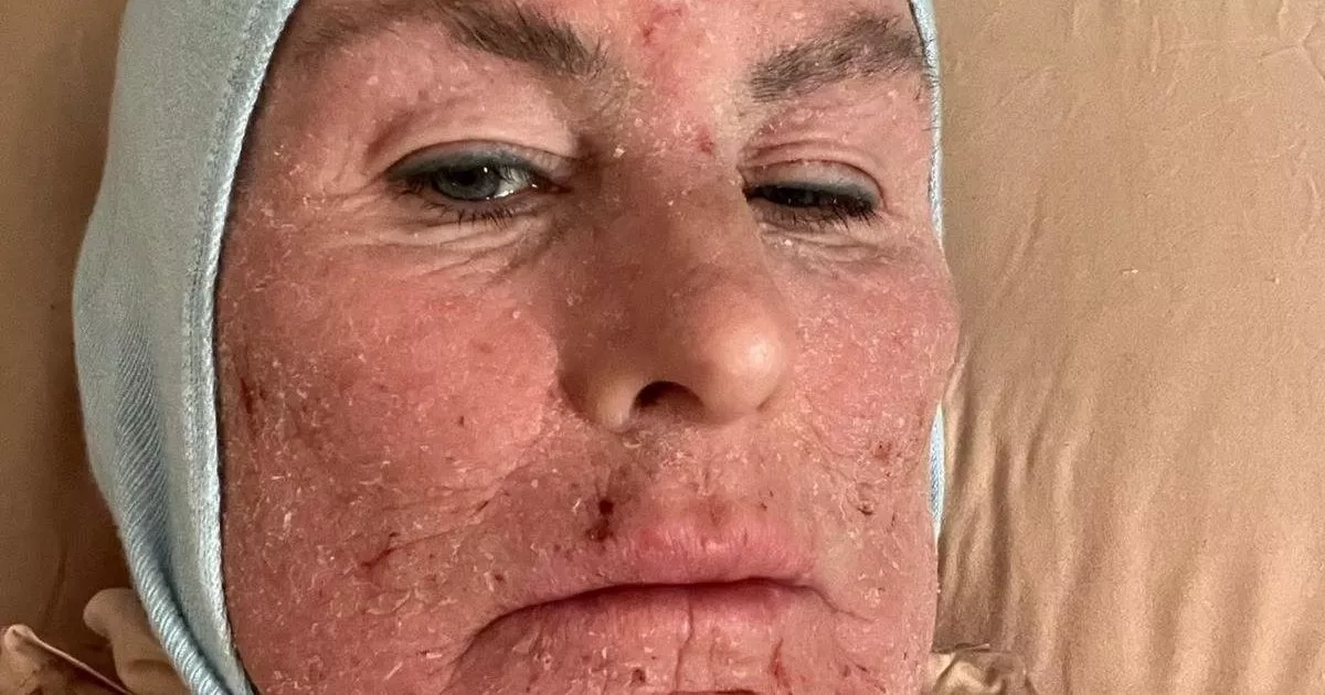 Scots mum with eczema says using steroid creams for 40 years 'has ruined life'