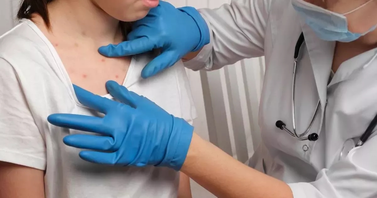Child with measles dies in hospital as experts fear virus 'could spread like wildfire'