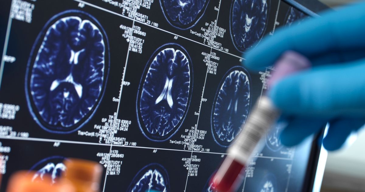 Morning tea or coffee could slash risk of Alzheimer's disease
