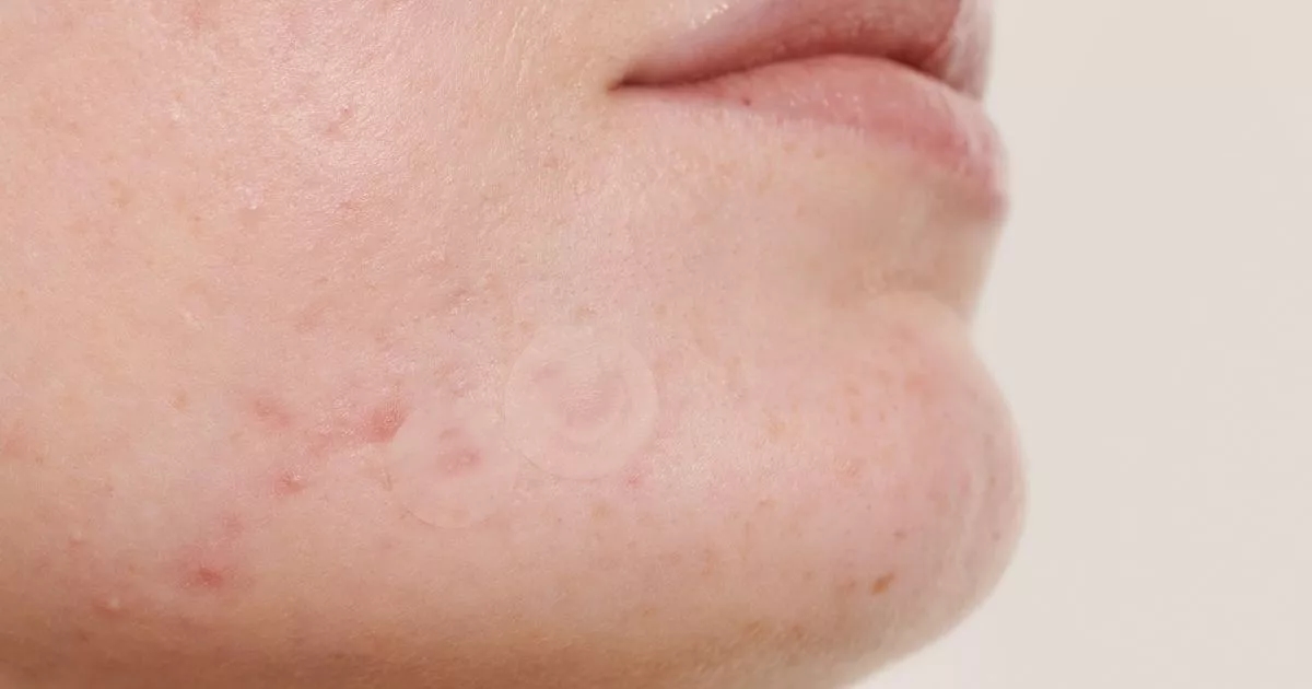 Shoppers praise 'invisible' pimple patches that can be worn underneath makeup