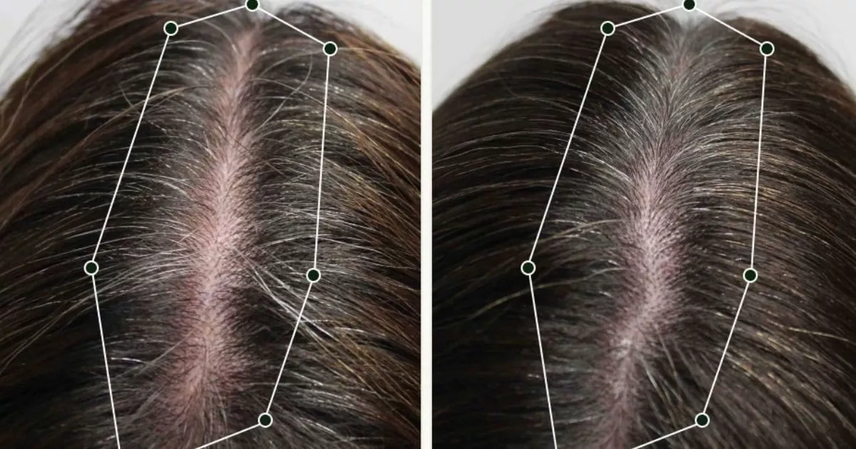 Women credit hair growth kit for boosting confidence with 'stronger and healthier' locks