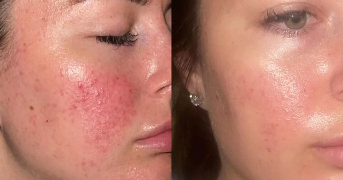 Shopper 'couldn't go a day without a spot' until they found this dermatologist-approved serum