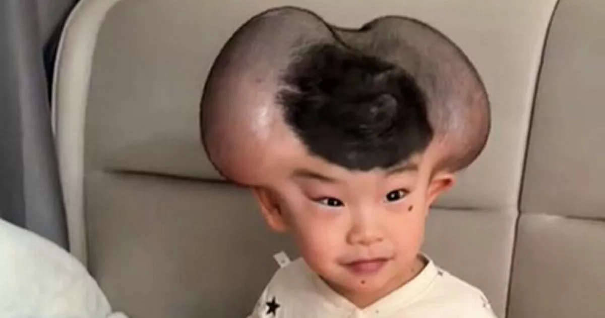 Boy nicknamed 'Mickey Mouse' due to rare condition makes wild transformation