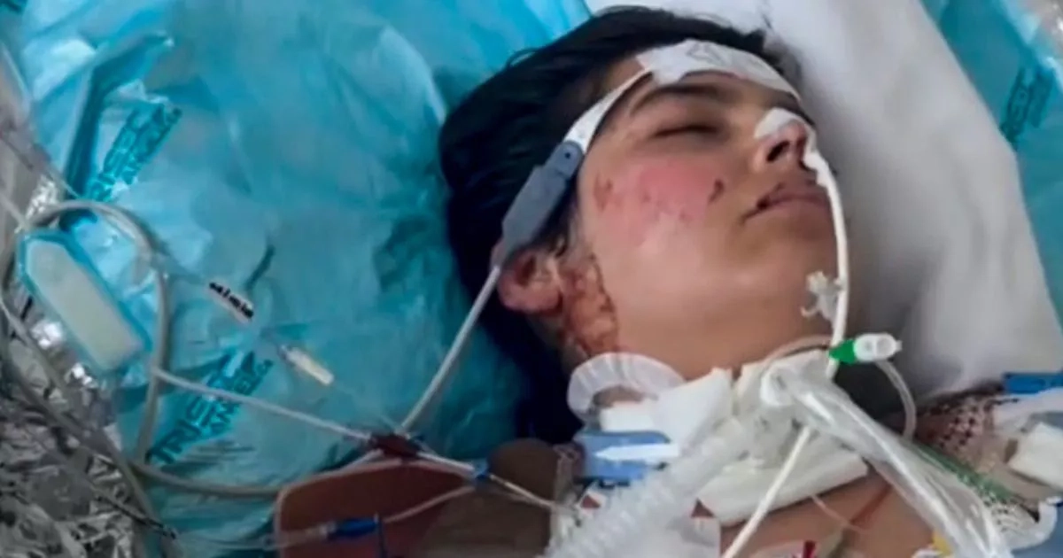 Dancer left with burns covering 90 per cent of body after fire dance goes wrong