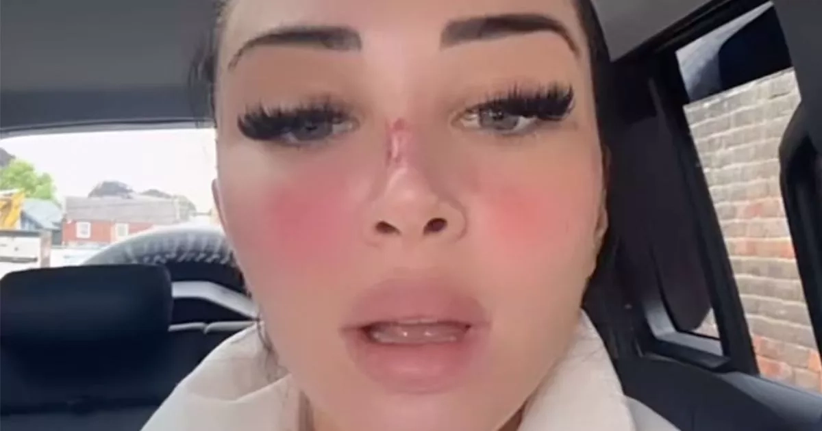 Tulisa shows off painful bloodied nose after undergoing six beauty treatments