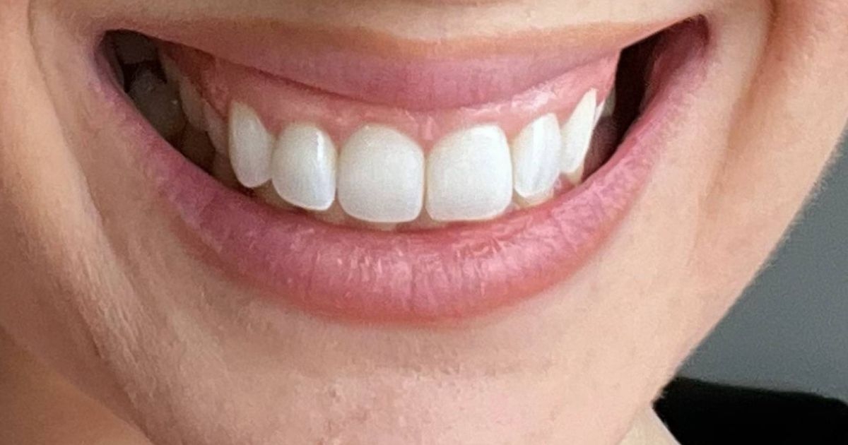 Teeth whitening solution 'removes stains' in time for summer
