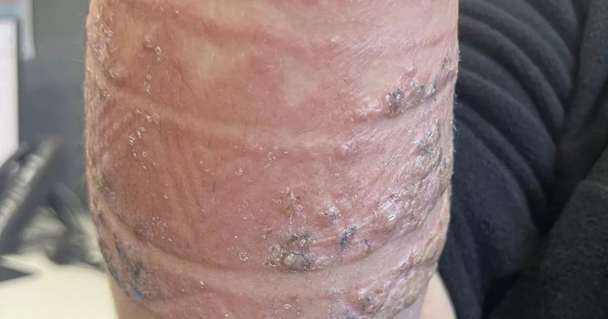 Mum shares horror pictures after son gets henna tattoo on Bali holiday