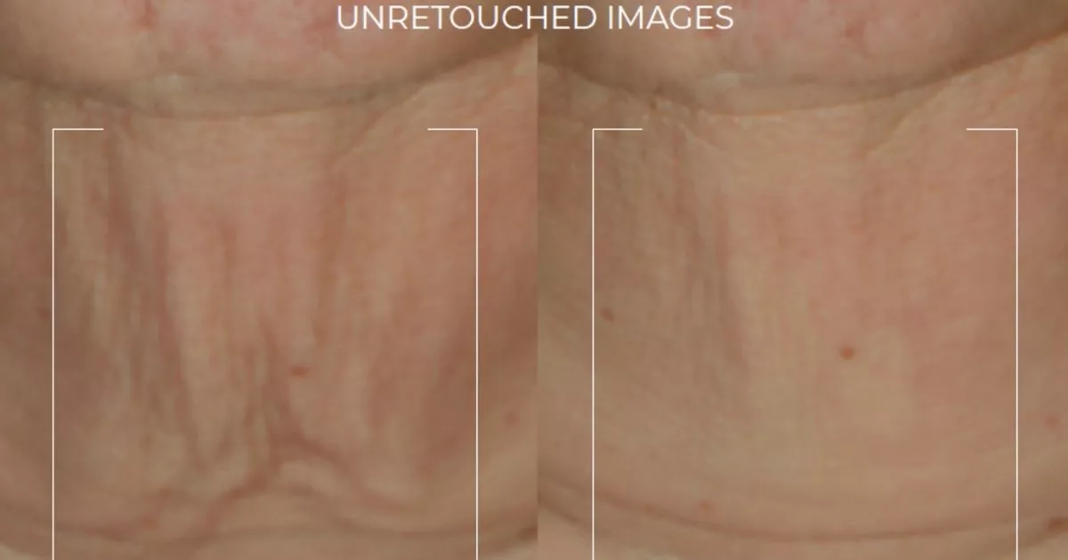 ‘Non-invasive neck lift in a stick' that shoppers call a ‘magic eraser for wrinkles'