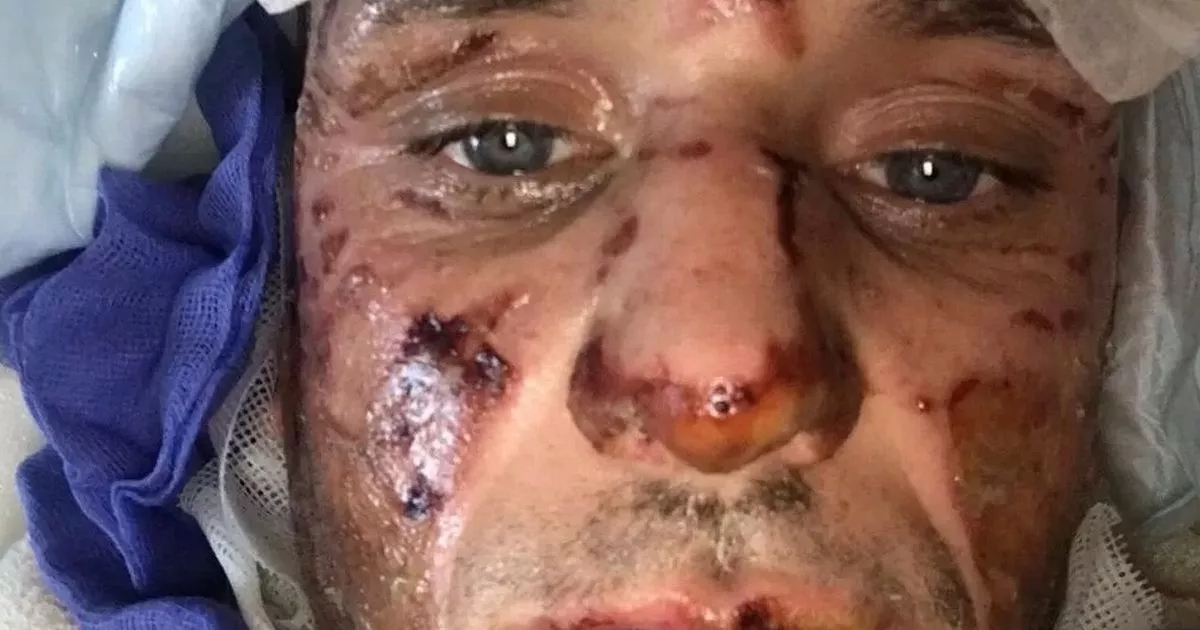 'Everything was normal at a house party - then suddenly I was being set on fire'