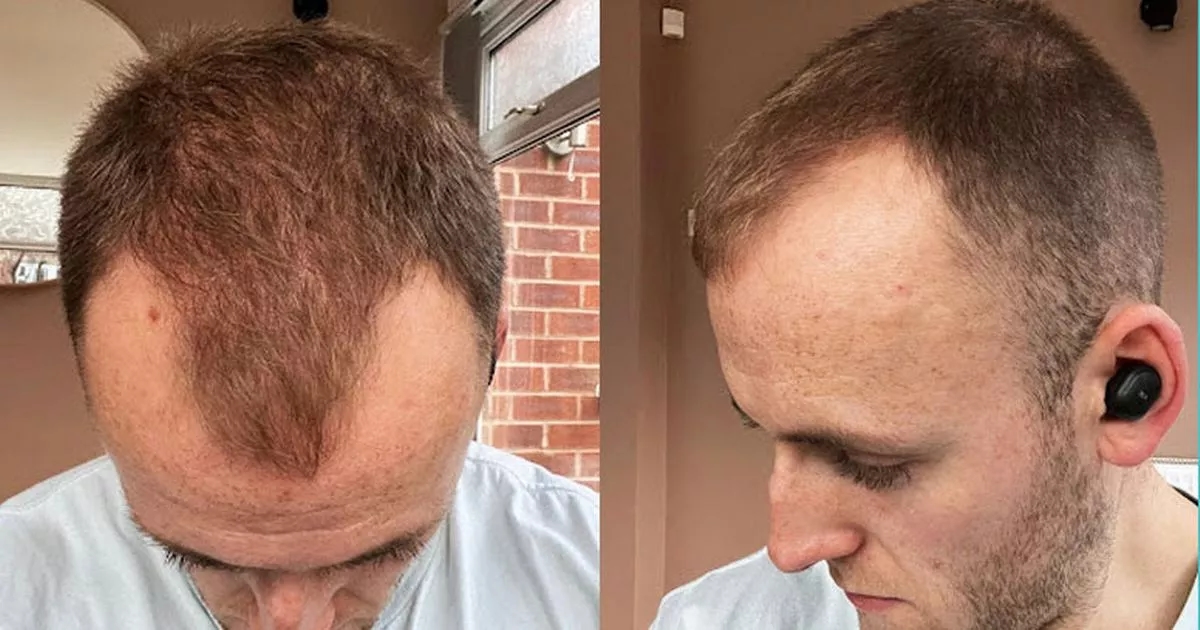 'I was dumped on first date for being bald - Turkish transplant transformed me'