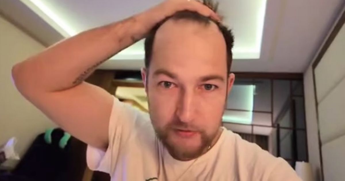 Man, 35, gets £3,220 hair transplant to avoid looking like one family member
