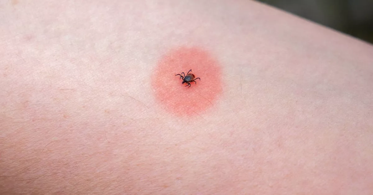NHS list of 14 different insect bites, their symptoms and how to treat them