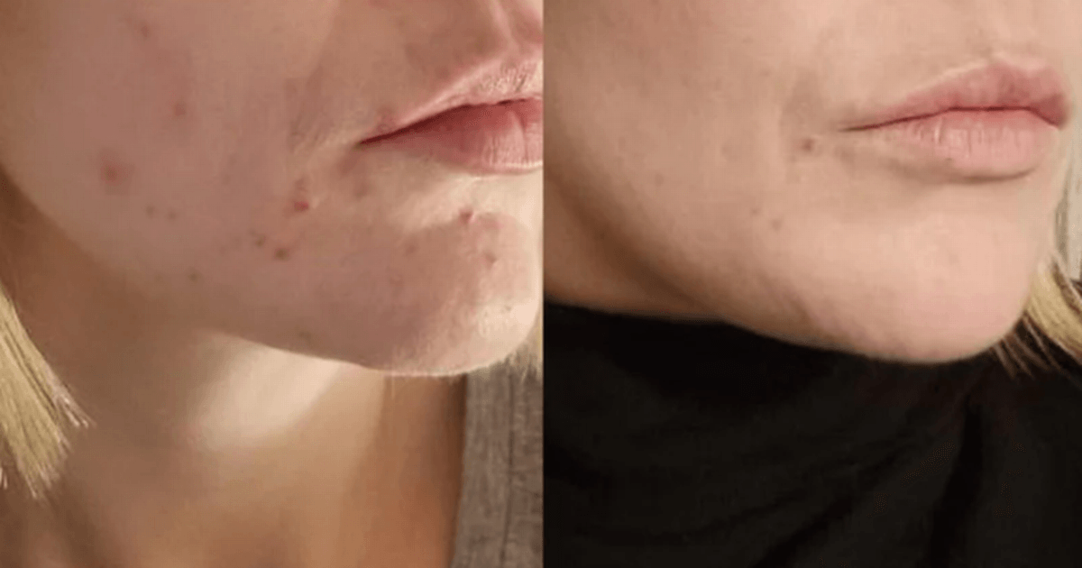 Skincare fans praise 'gentle' face gel that targets blemishes 'overnight'