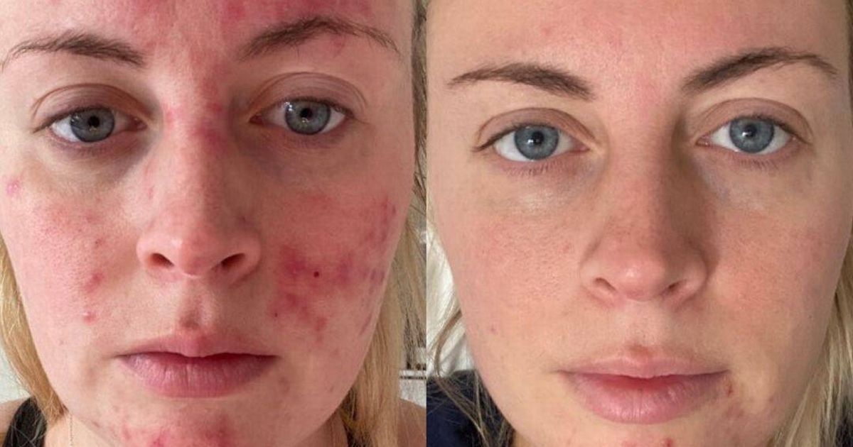 Shoppers' skin clears in 'four days' thanks to ingredient exclusive to one brand