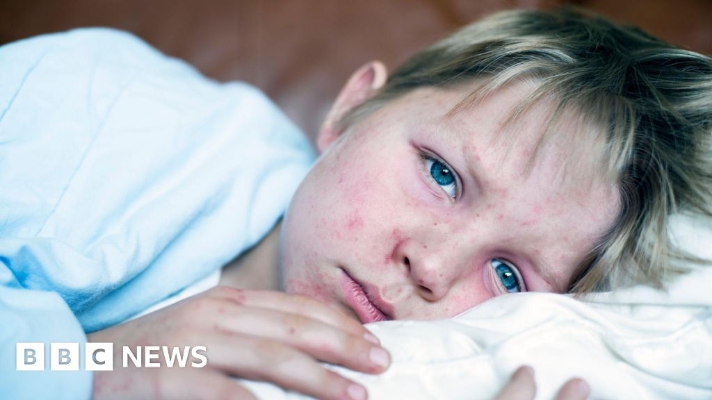 Parents warned as measles cases rise in Bristol