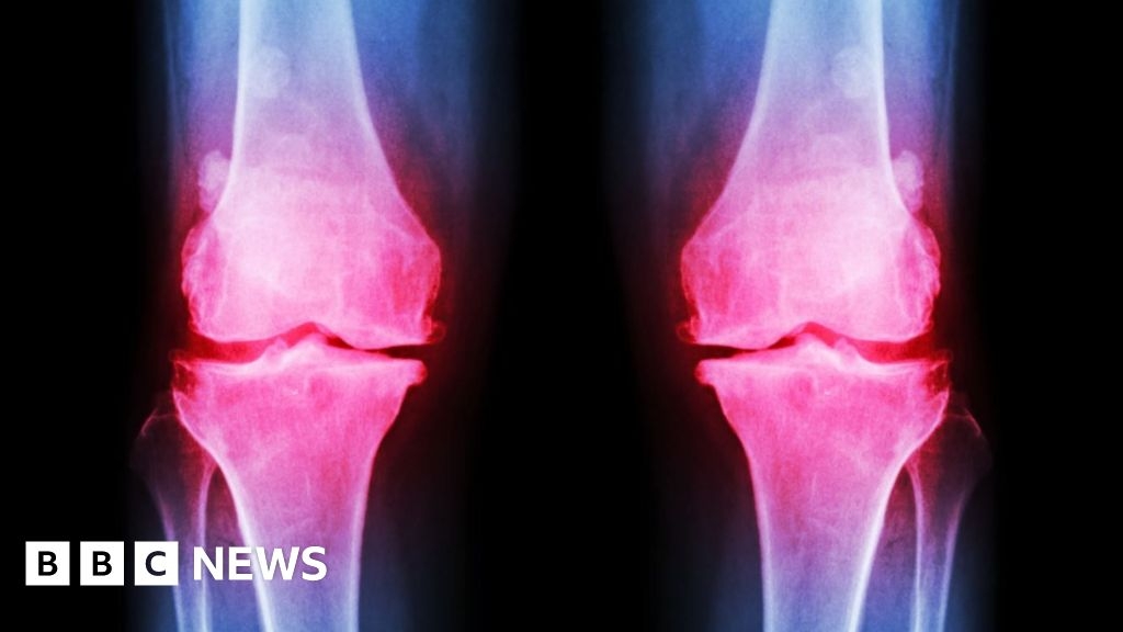 Global NHS osteoarthritis study could lead to new treatments