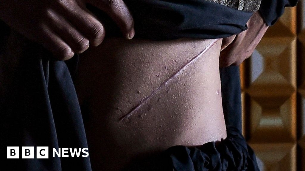 Kidney trade: Myanmar villagers fly to India to sell organs illegally