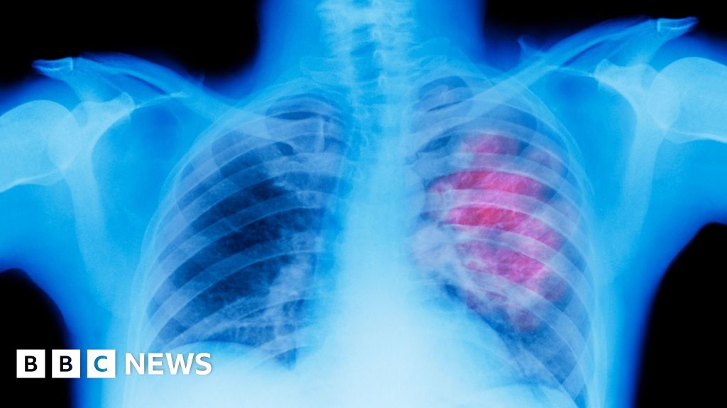 Lung cancer screening for smokers and former smokers in Wales