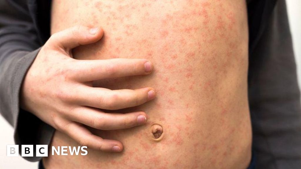 Measles warning for holidaymakers heading to Europe