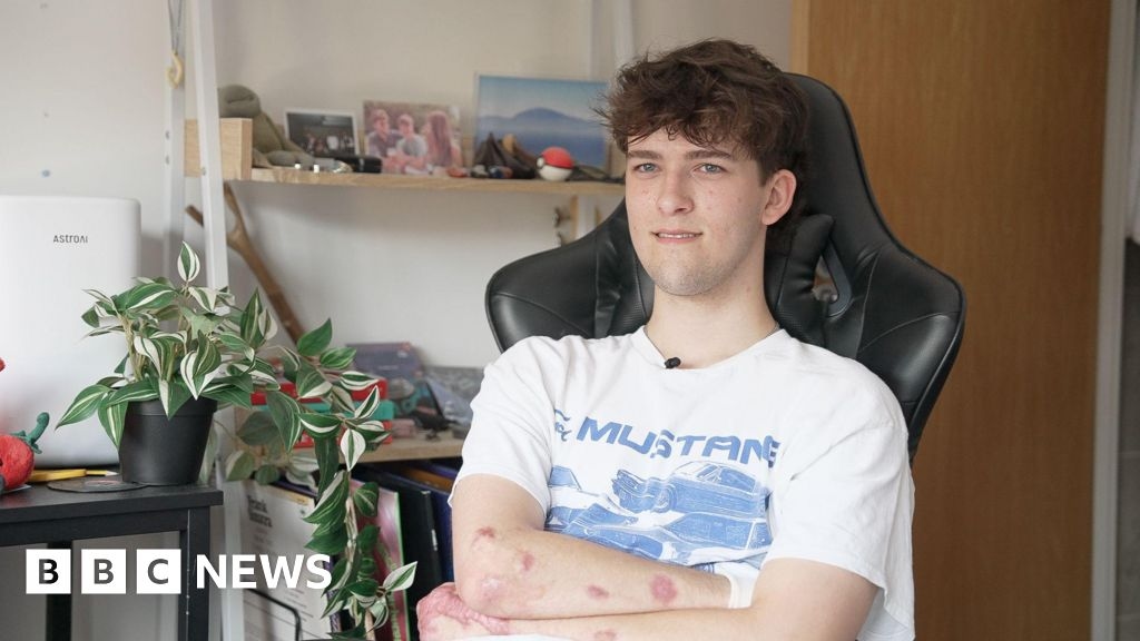 Sepsis: Teen Hamish Wilson 'rebuilding his life' after surgery