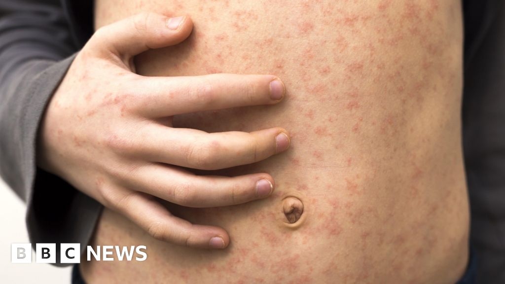 Measles outbreak in Knowsley as vaccine rates drop
