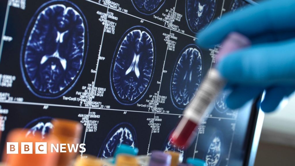 Breakthrough Alzheimer's drugs too pricey to be offered on NHS