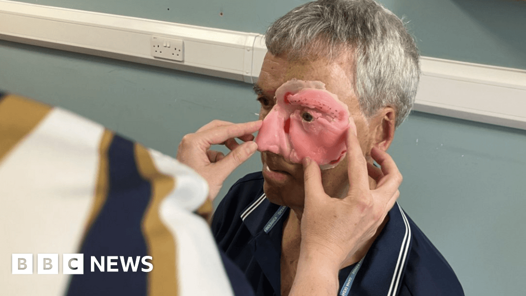 Cyclist get 3D printed face after bike accident