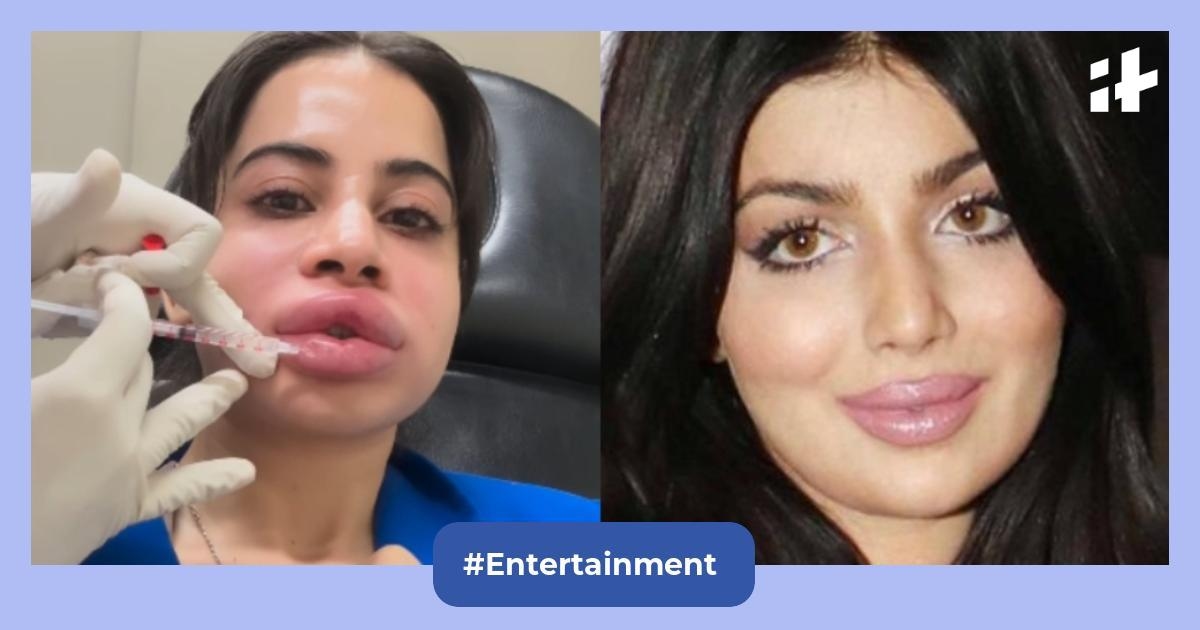 Shocked by Uorfi Javed's lip filler removal? Here are 5 times celebrity cosmetic surgeries went horribly wrong