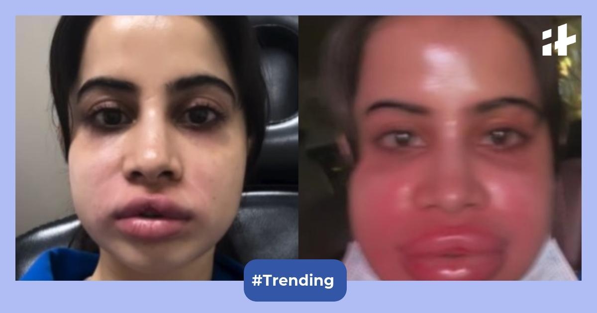 Here's what went wrong with Uorfi Javed's filler dissolution; experts highlight what happens when a face enhancements is dissolved