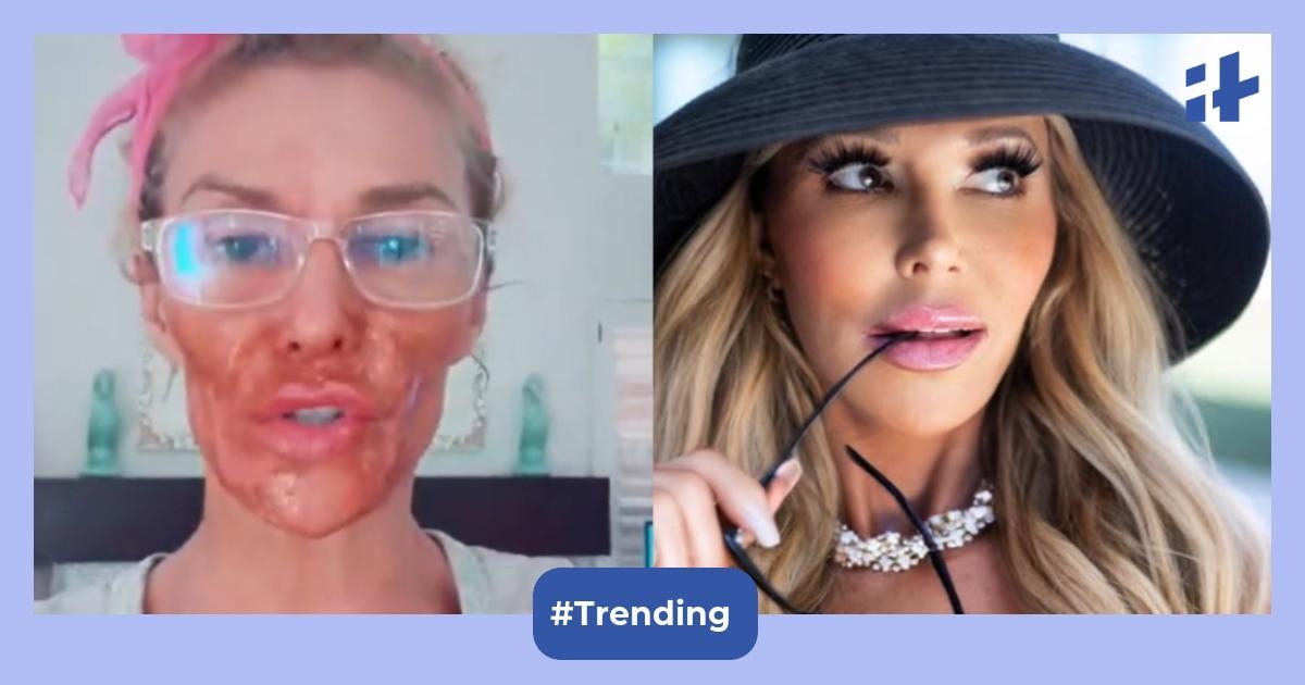 ‘Self-harming for sympathy?': Brandi Glanville faces backlash over bizarre skincare mishap