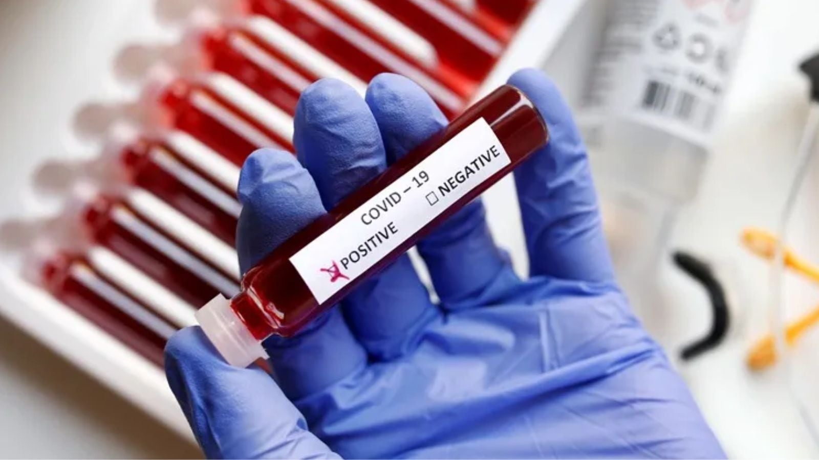 Woman tests positive for Covid-19 in Mohali; authorities say no cause for panic