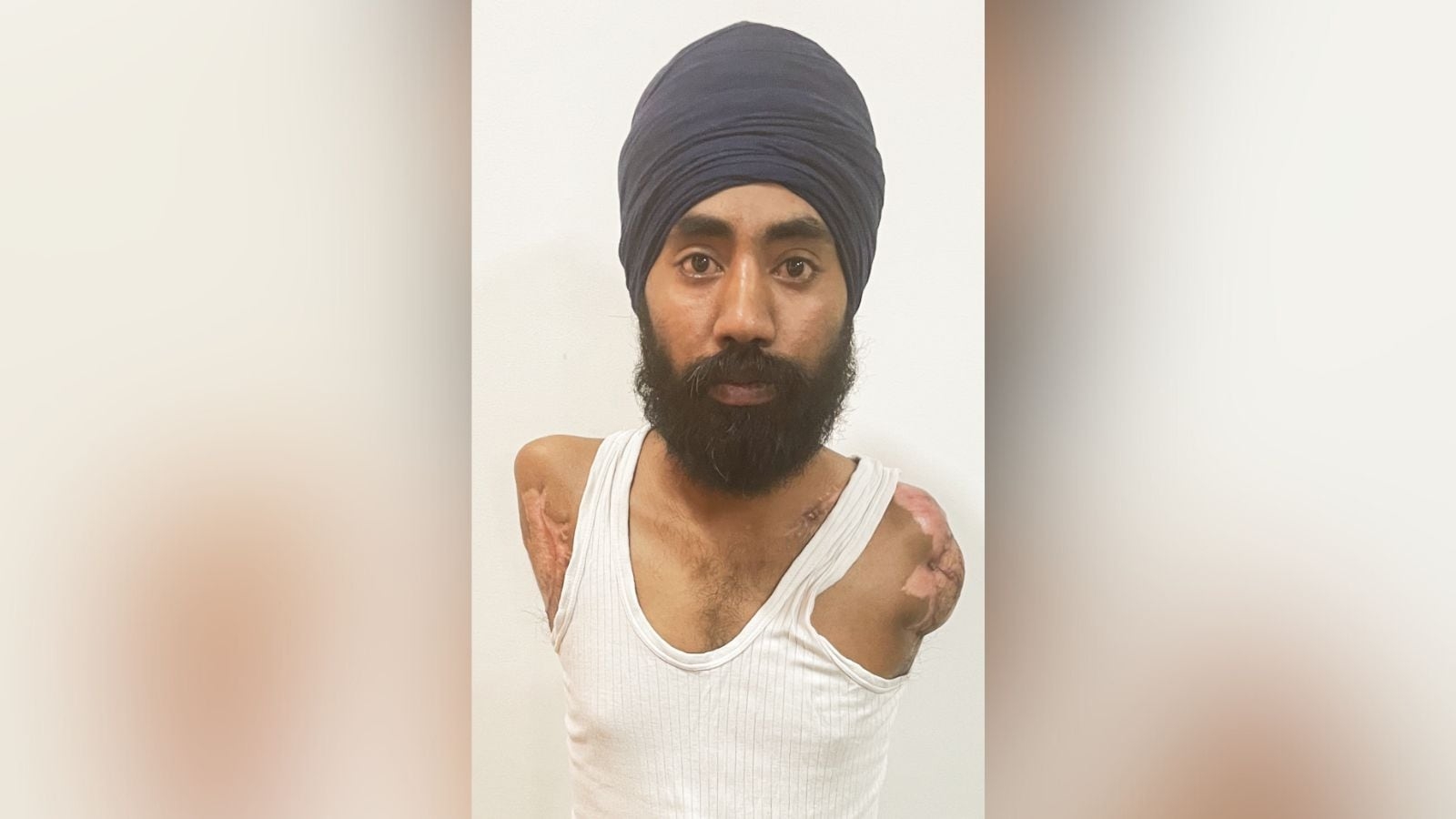 With both arms lost at work, monthly pension proving elusive for Satnam