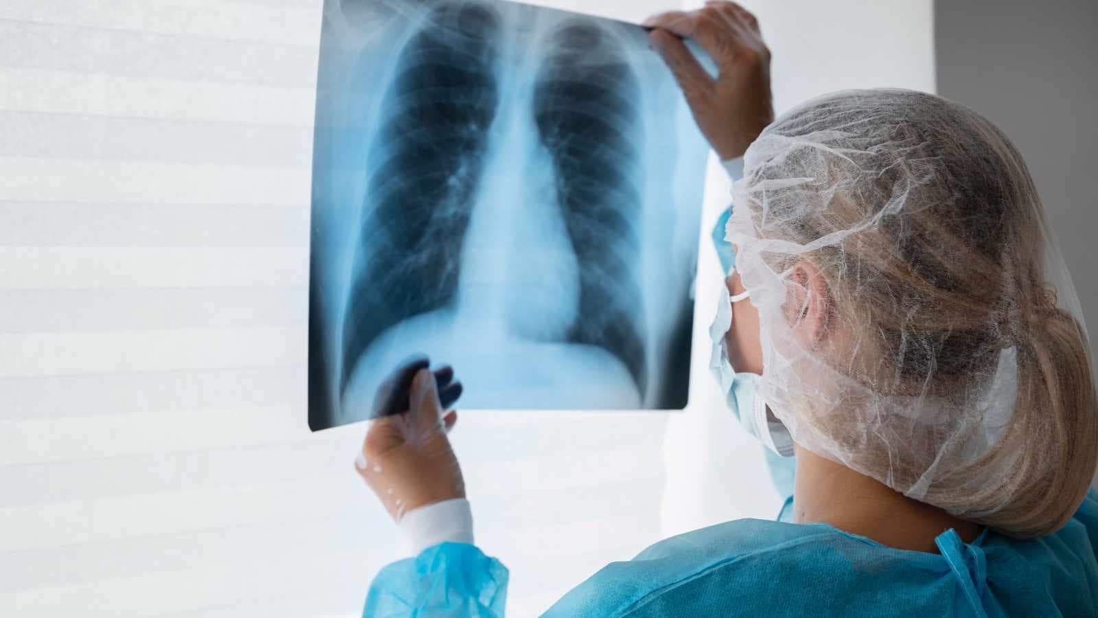 How this TB triage tool experiment in Tamil Nadu reduced death by 20 per cent: Can it be used in national programmes?