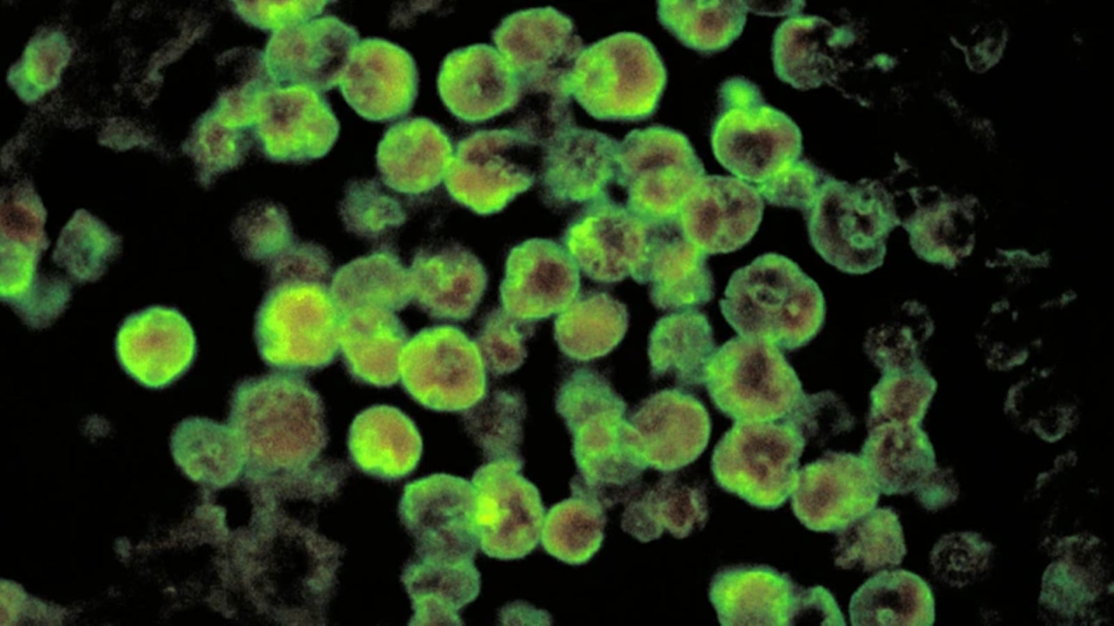 9-year-old girl dead as Kerala's Kozhikode sees 3 cases of ‘brain eating amoeba'