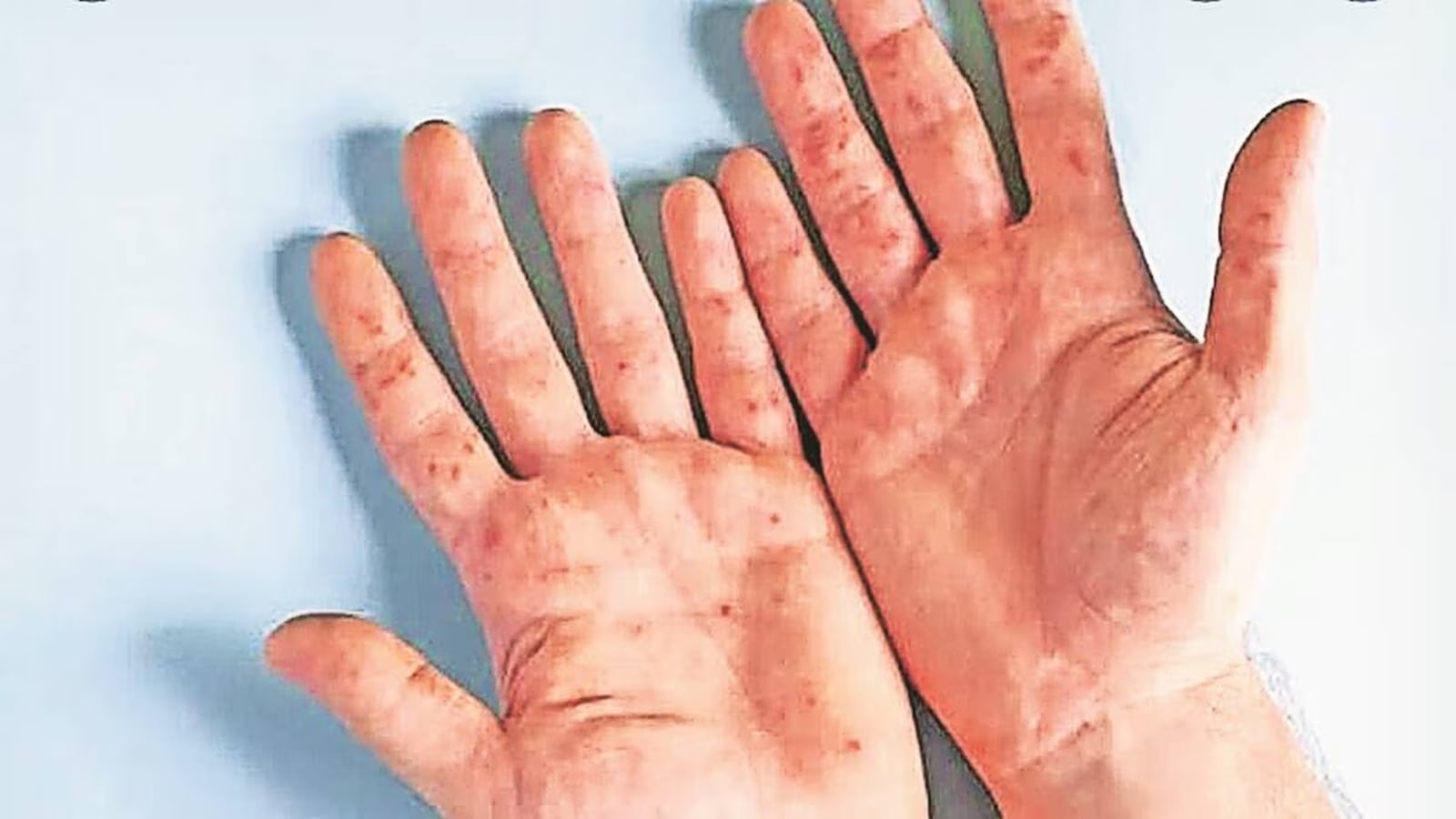 What Is Hand, Foot and Mouth Disease? What should parents do to protect their kids? A doctor explains