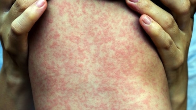 Measles-infected infant dies in southwestern Ontario