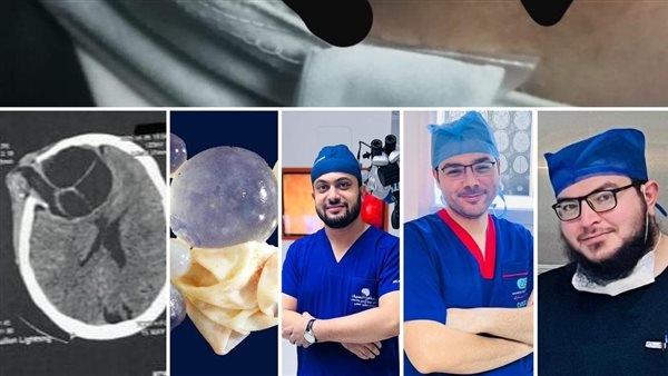 عملية نادرة تنقذ مريضة من كيس مائي بالمخ بمستشفى 15 مايو التخصصى